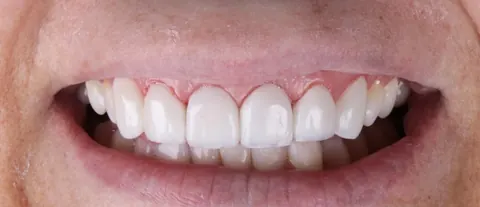 Sorriso de paciente depois de facetas em resina