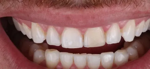 Antes: dentes pequenos e desiguais