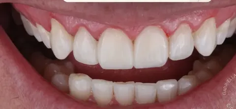 Depois: facetas em resina composta
