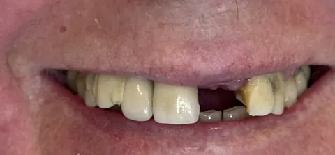 Antes: falhas e dentes desgastados