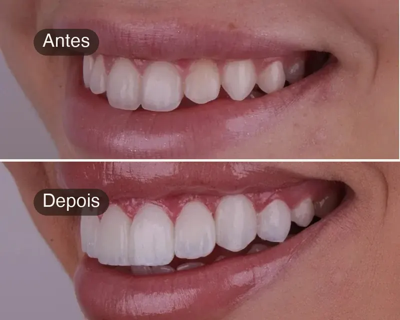 Antes e depois de tratamento estético do sorriso, caso real