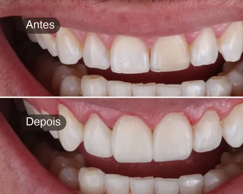 Antes e depois de facetas em resina composta, caso real