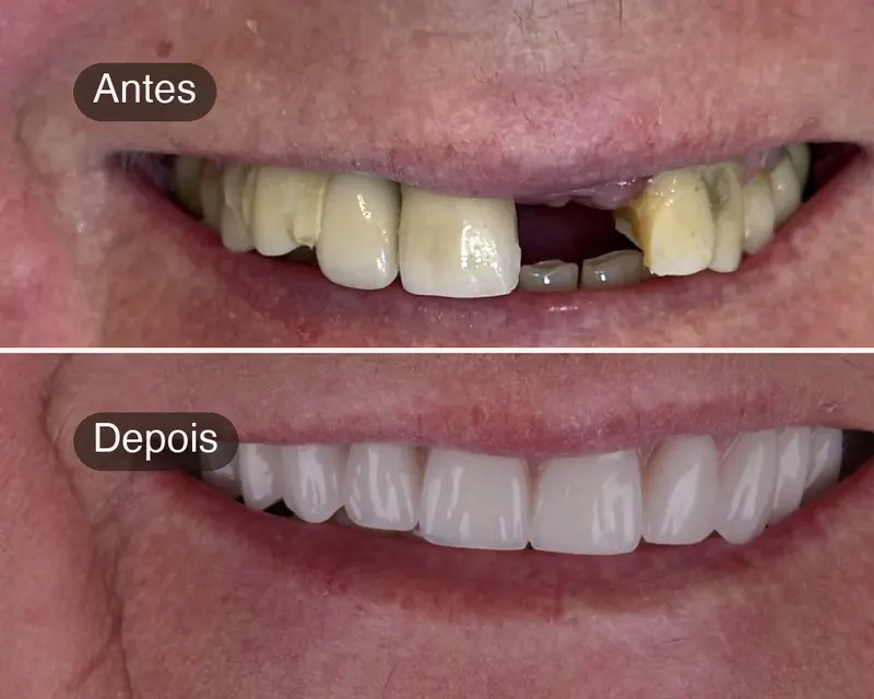 Antes e depois de prótese fixa sobre implante, caso real